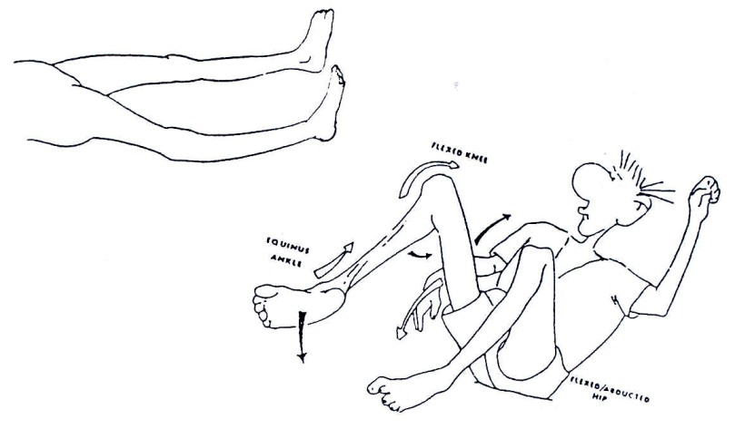 Muscleatrophy.jpg
