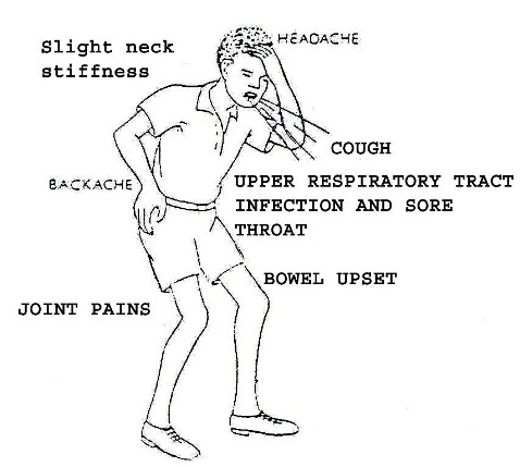 Earlypresentationpolio.jpg