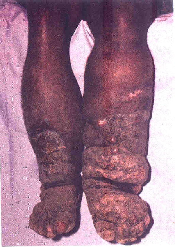 Filariasis.jpg