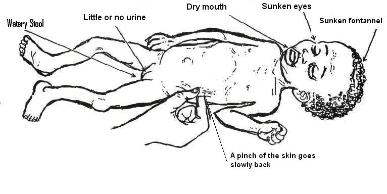 Signsdehydration.jpg