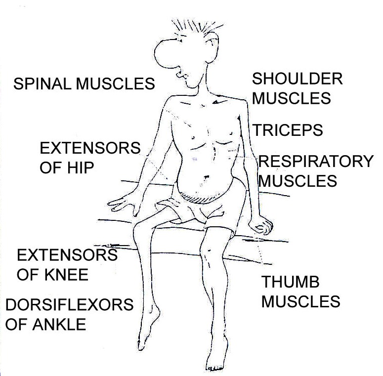 Musclescommonlyaffected.jpg
