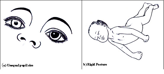 Signsofmeningitis.jpg