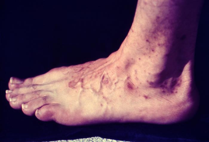 File:Ringworm.jpg